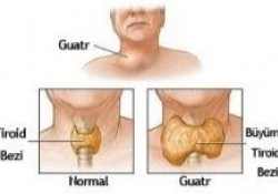 Tiroid Hakkında Bilmeniz Gerekenler